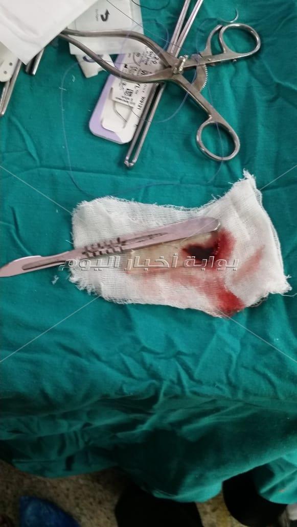 مستشفي سوهاج الجامعي يستخرج جسم زجاجي من صدر شاب "قنائي" في العقد الثالث   
