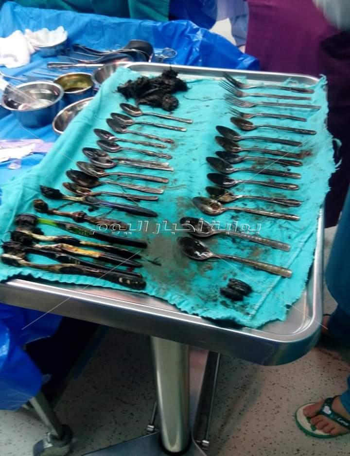 فريق جراحى  بجامعة المنصورة  يسخرج أدوات المائدة وأجسام غريبة من بطن شاب