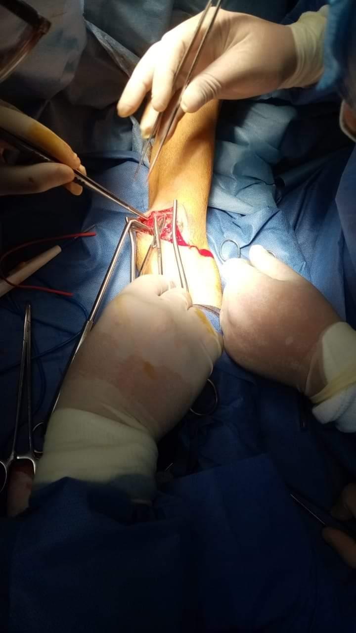 إجراء جراحة أوعية دموية 