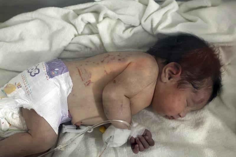الكدمات ظاهرة على جسد طفلة سورية ولدت تحت الركام فيما توفيت والدتها - أ ب