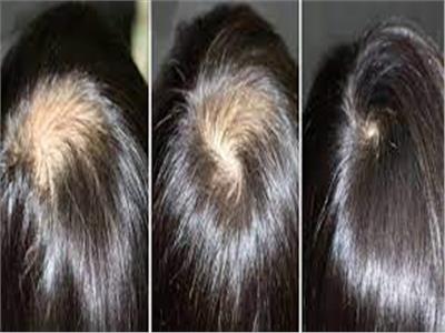 تعرف على الفرق بين الثعلبة وفراغات الشعر وأعراضها