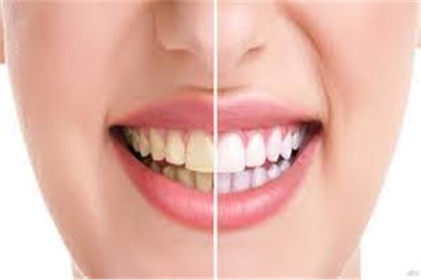 عوامل تغيير لون الأسنان 