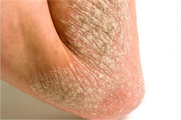 3 طرق للتخلص من مشكلة «جفاف الجلد»