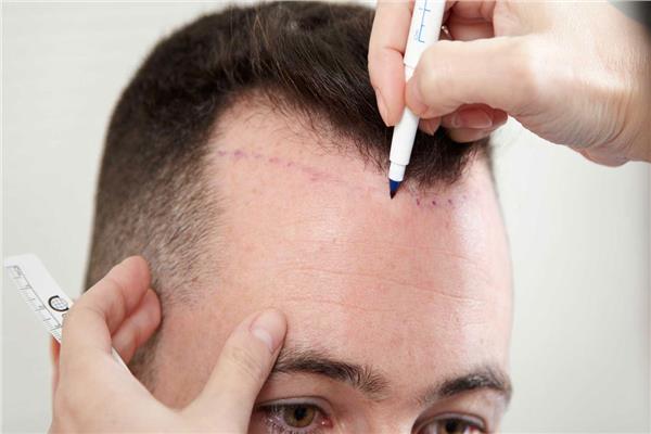 جراح تجميل يوضح نصائح للمقبلين على عمليات زراعة الشعر  
