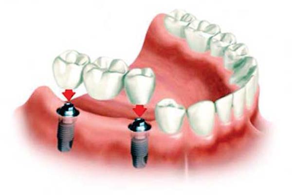 صورة توضيحية لبعض تركيبات الأسنان