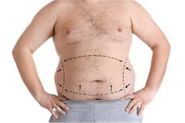  أنواع عمليات شفط الدهون للرجال