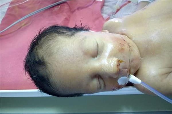 فريق طبي بالمحلة ينجح في اجراء عملية لرضيعه ولدت بعيب خلقي 