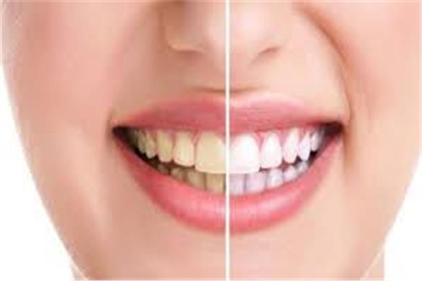 في اليوم العالمي للابتسامة .. طرق الحفاظ على أسنانك من الإصفرار