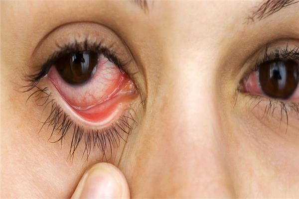 6 نصائح لعلاج جفاف العين 