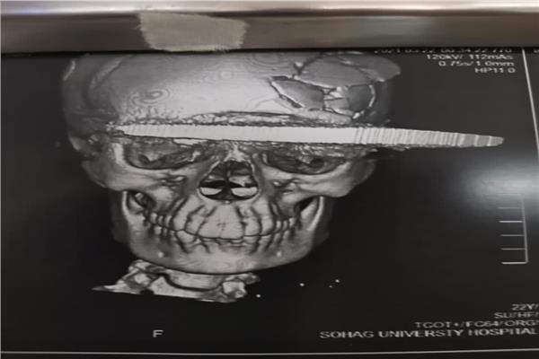 إحدى صور الأشعة للمصابة