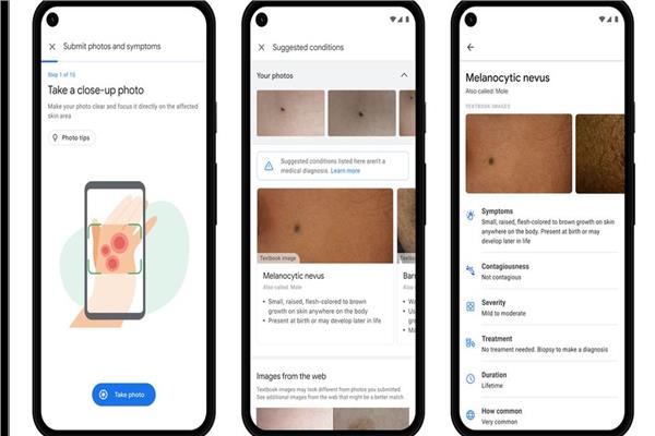 جوجل تعمل على تقنية  تساعد المرضى في التعرف على حالات الجلد 