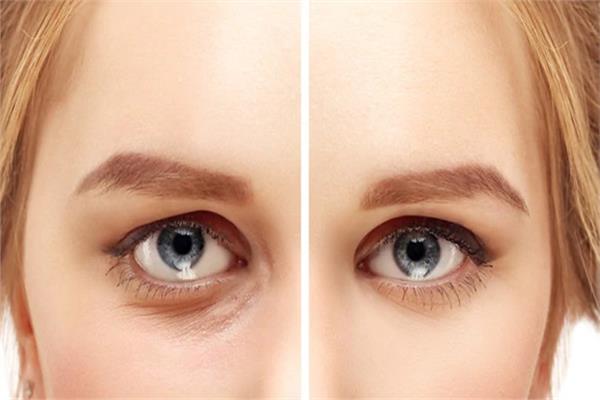 علاج سحري للعيون المنتفخة