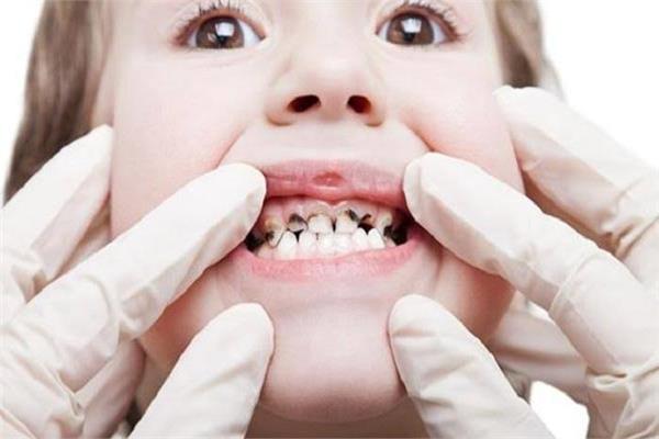  مرض تسوس الأسنان 