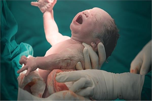الولادة القيصرية - صورة أرشيفية
