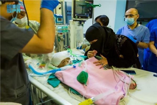 نجاح أطباء سعوديون بفصل توأمين سياميين يمنيين 