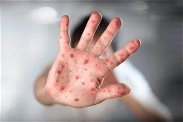 Le ministère français de la Santé signale deux nouveaux cas de « monkeypox »