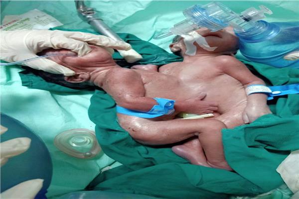إجراء عملية ولادة قيصرية دقيقة لتوأم ملتصق في مستشفيات جامعة أسيوط