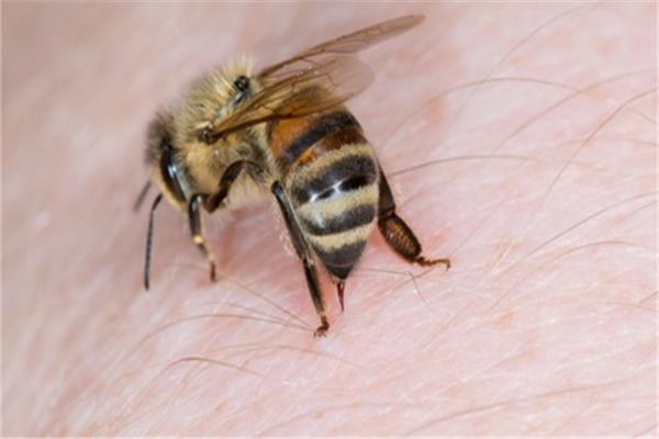  حساسية لسعات النحل والدبابير