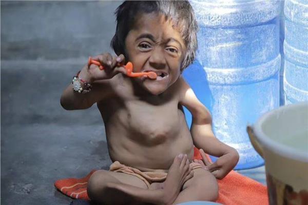  طفل هندي أصيب بمرض العظام الزجاجية