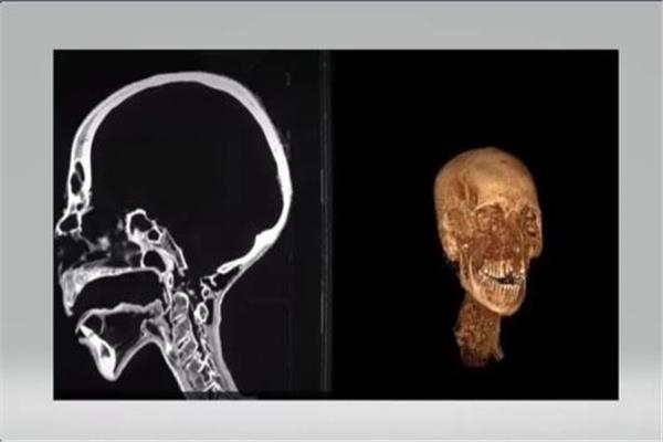رأس مومياء مصرية عُثر عليها بمنزل طبيب بريطاني