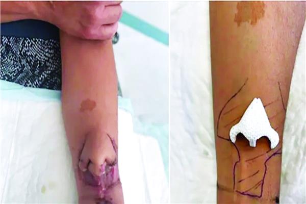 نمّت امرأة في فرنسا أنفاً على ذراعها