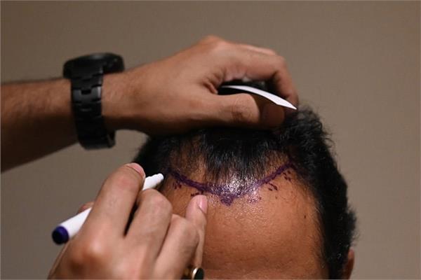 عملية زراعة شعر في الهند