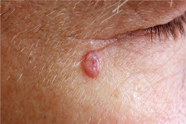 سرطان الجلد غير الميلانيني
