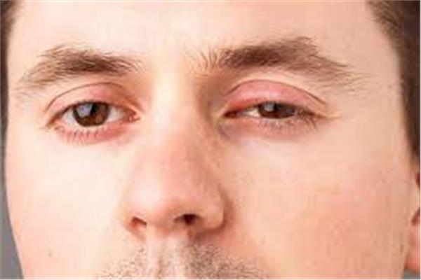 نصائح لعلاج تورم العينين