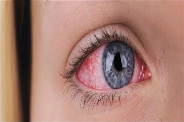 التهابات العين قد تسبب لك الوفاه 
