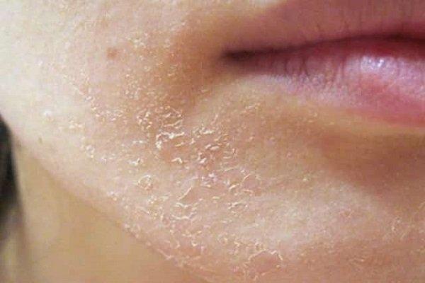 أسباب شائعة قد تؤدي إلى جفاف الجلد 