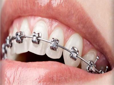 تعرف على مميزات «تقويم الأسنان» المتحرك ومدة التركيب