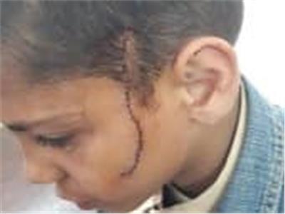 أحدهم أصيب بـ30 غرزة.. خناقة أطفال بـ«موس حلاقة» في مدرسة بالمرج