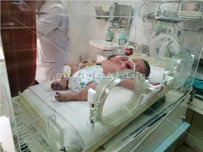 صور| ولادة طفل برأسين وقلب واحد في أسوان