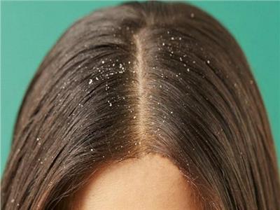 3 وصفات طبيعية للتخلص من «قشرة الشعر»