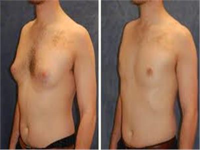 طبيب استشاري يوجه نصائح حول عملية تصغير الثدي عند الرجال؟