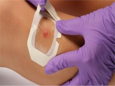«لاصق طبي» يكشف سرطان الجلد في وقت قصير