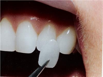 «استشاري»: عدسات الأسنان اللاصقة تقنية تجميلية
