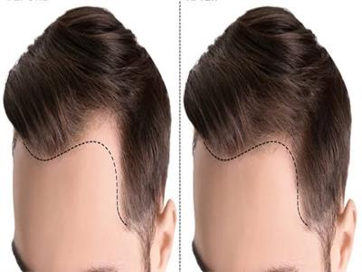 جراح تجميل يوضح الفوائد الأكثر أهمية لعملية زراعة الشعر 