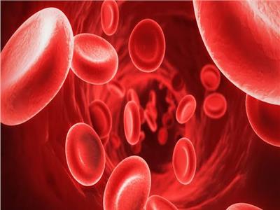 بحث جديد عن "فقر الدم المنجلي" لمن يعانون من زيادة نسبة الحديد في الدم