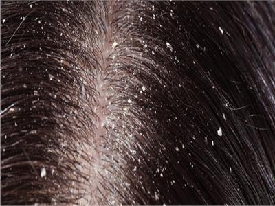 كيف تتخلصين من قشرة الشعر بعناصر «طبيعية» ؟