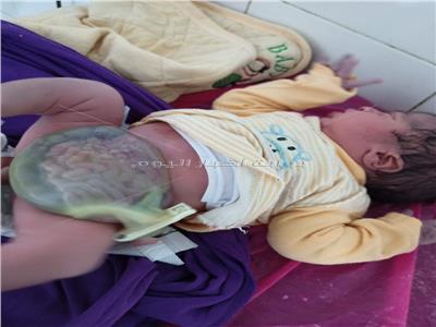 جراحة عاجلة لمولود بـ«أمعاء خارج تجويف البطن» في بني سويف