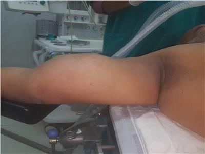 استئصال ورم ساركومي متضخم من ذراع مريض بمركز أورام طنطا