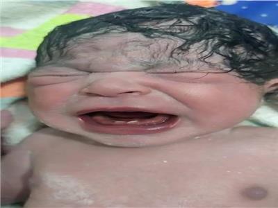 حالة ولادة نادرة بسوهاج «سيدة تضع مولودة بسنتين»