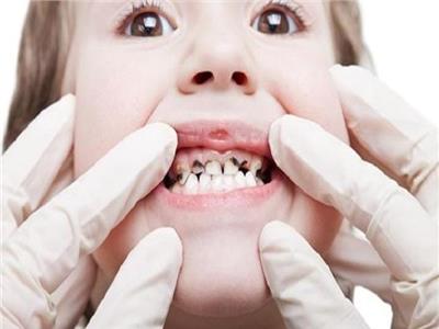 كيفية تفادي تسوس اسنان اطفالك 