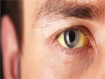 5 أسباب لاصفرار العين.. أبرزها فقدان الوزن 