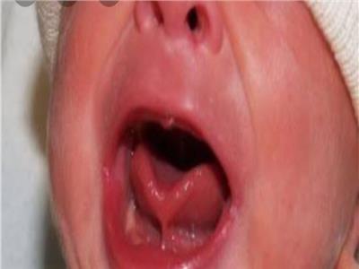أعراض اللسان المعلق عند حديثي الولادة