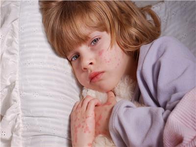 خبير روسي يكشف أسباب إصابة الأطفال بالحساسية