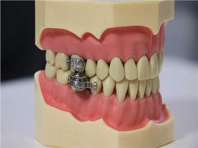 «قفل الأسنان».. أحدث الطرق للتخلص من السمنة