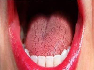 ٨ أعراض شائعة لجفاف الفم الناتج عن الإصابة بالسكري