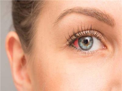 تخلص من احتقان العين الدموي في 6 خطوات